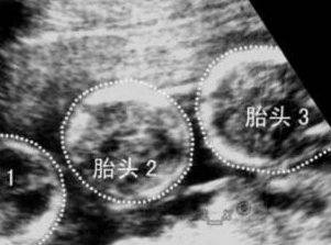 上海集爱高龄试管三代成功率与治疗方案全面解析